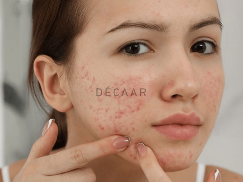 Mụn viêm ở má là một trong những tình trạng da liễu thường gặp